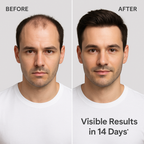 Pack of 2 FEG Hair Growth Spray Plus Derma Roller, Suitable For Both Men and Women